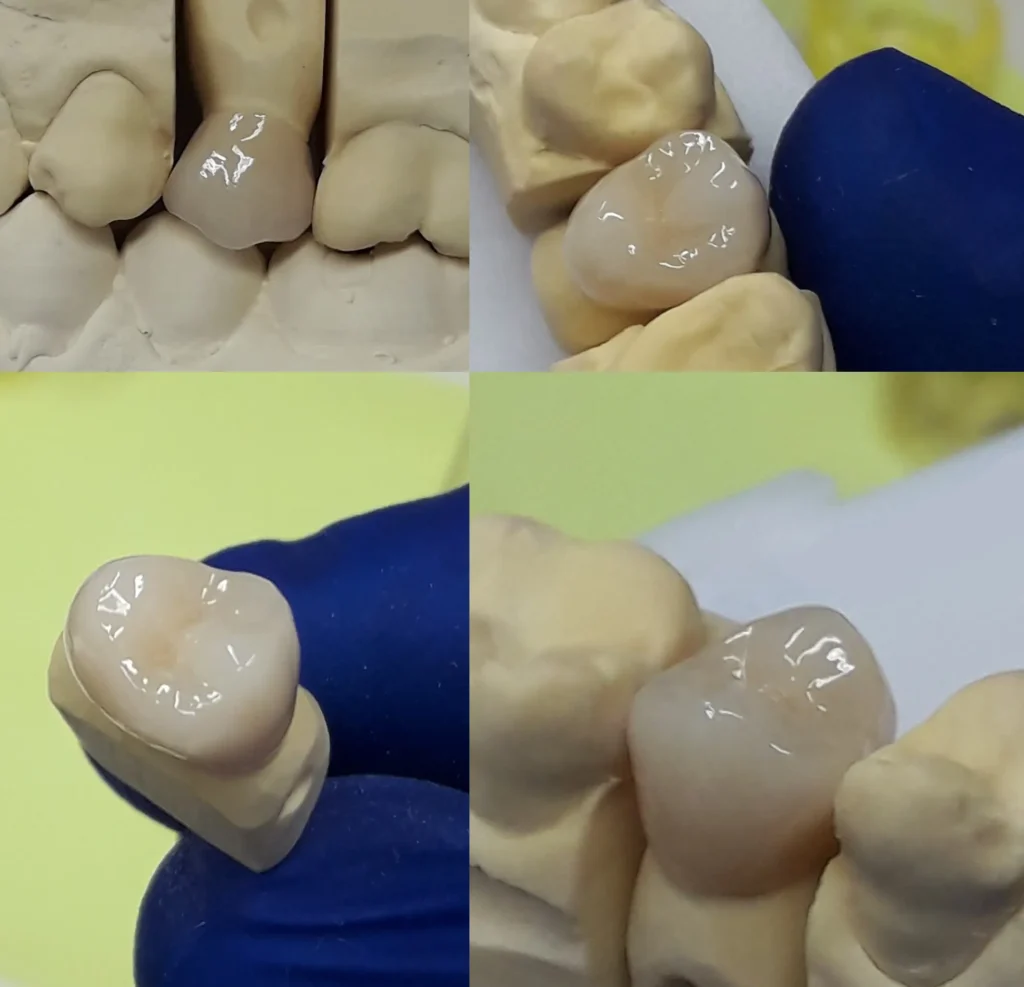 Zahnersatz Augsburg Krone